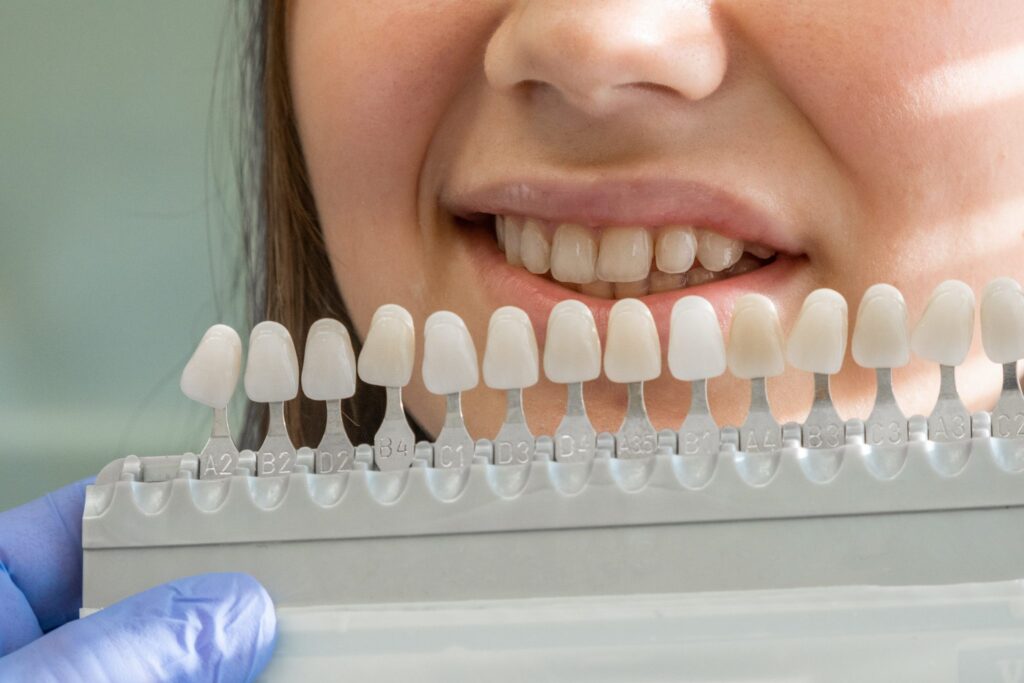 Dental Veneers Craigieburn