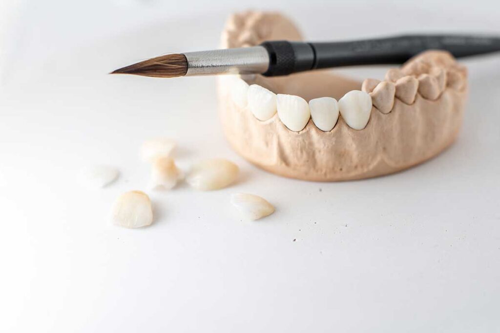 Veneers in Glenroy