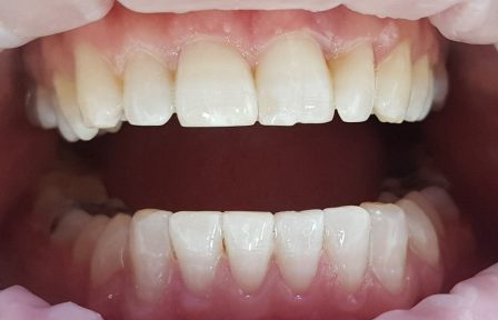 dental teeth